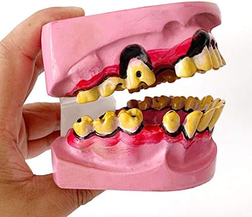 Lemita מעשנים אנושיים שיניים פתולוגיות מודל דרך הפה - חינוך מודל שיניים - הפגנת מחלות שיניים מחקר לימוד שיניים מודל - לסיוע